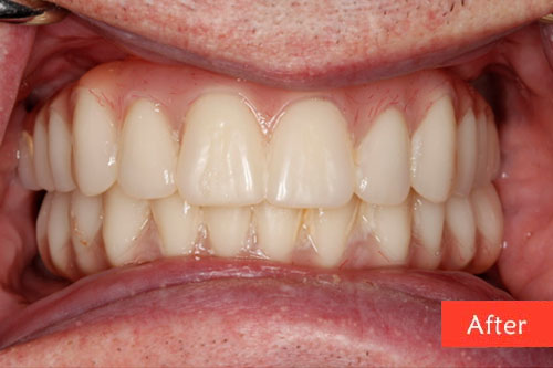 after dental implant 3