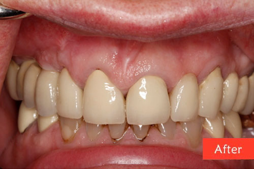 after dental implant 4