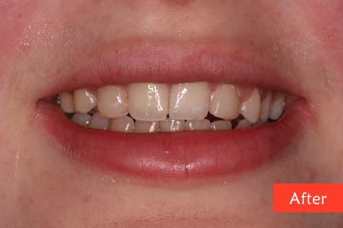 dental composite build after images

